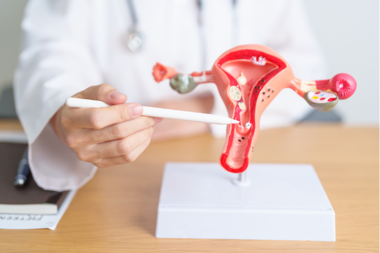 Uterine Fibroids