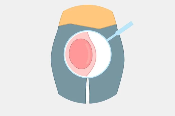 Bartholin’s Cyst Excision