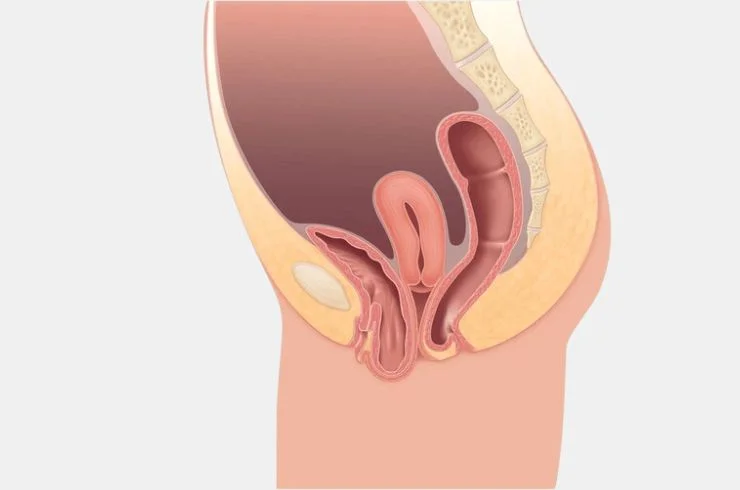 Cystocele Repair