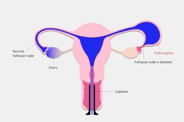 HSG (Hysterosalpingogram)