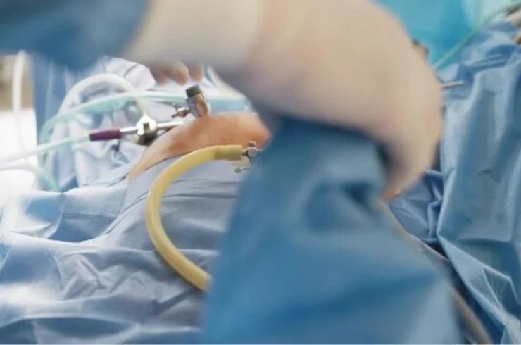 Laparoscopic Hysterectomy