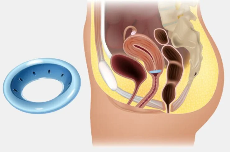 Uterine Prolapse Surgery