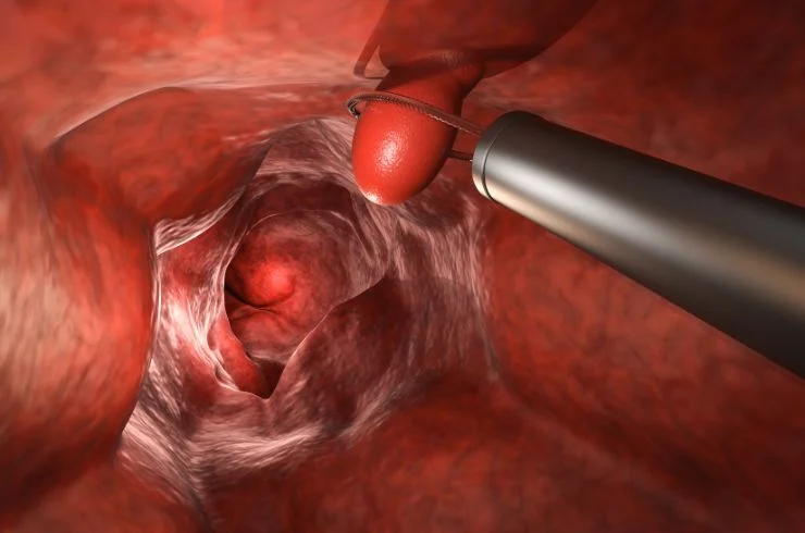 Hysteroscopic Polypectomy